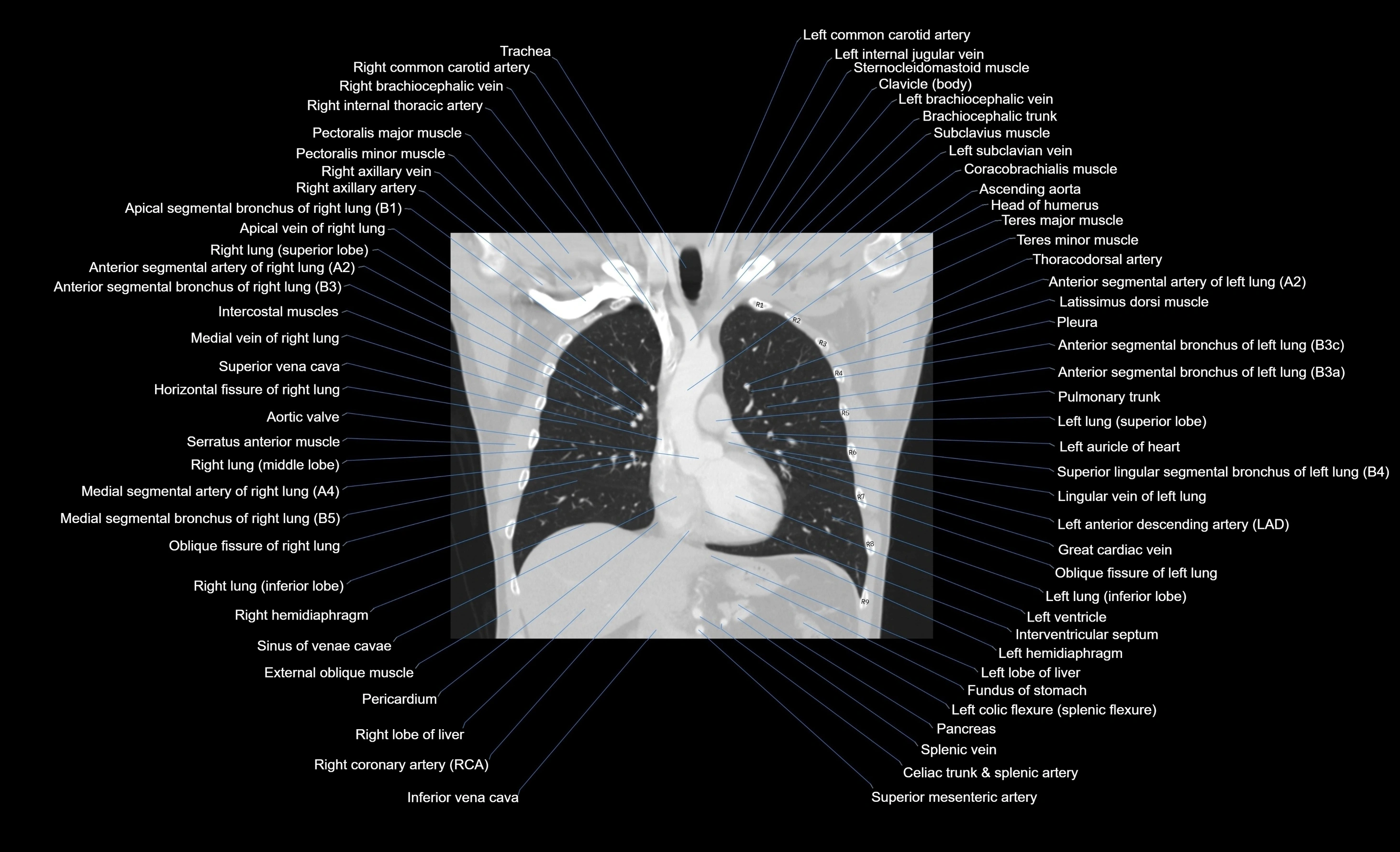 CT chest (thorax) lung window window labelled coronal cross sectional anatomy radiology image-00070.webp